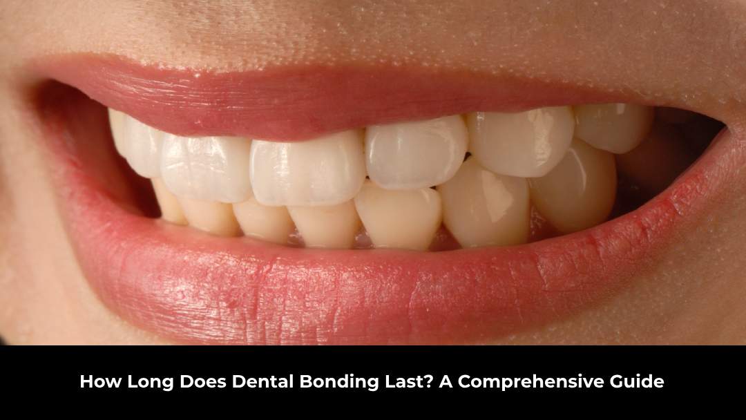 How Long Does Dental Bonding Last? A Comprehensive Guide